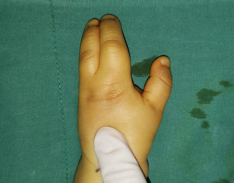 并指畸形免植皮案例,并指畸形