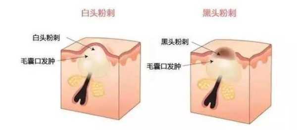 小孩下巴长白色颗粒小凸起,下巴小颗粒和粉刺怎么去除