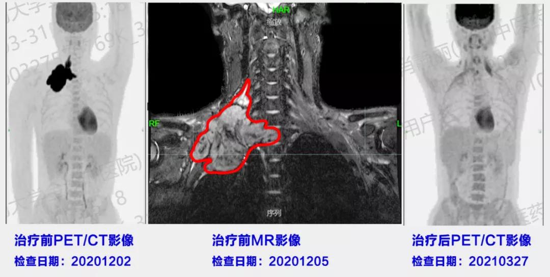 最佳治疗淋巴瘤方法,得了淋巴瘤用什么化疗药