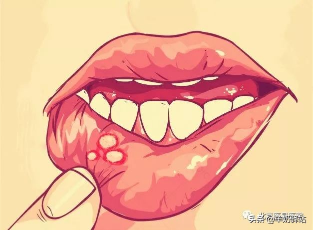 口腔溃疡中医小妙招,口腔溃疡可以吃四黄泻火片