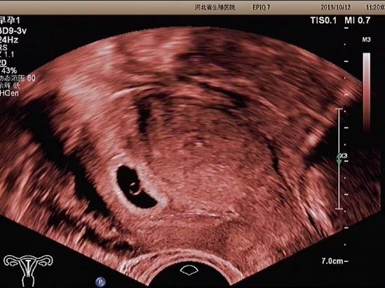 阴式彩超会碰到孩子么,经阴超声检查有害吗