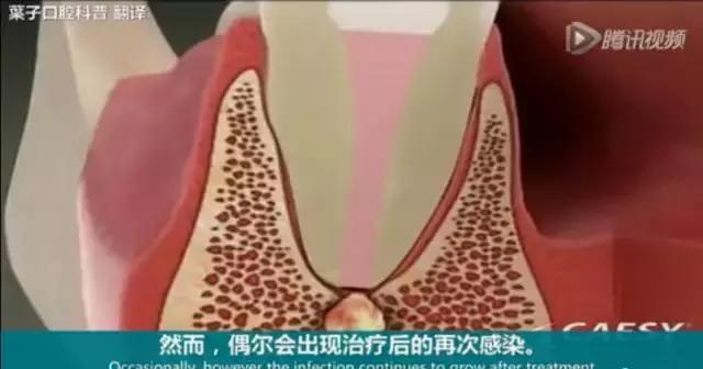 牙龈反复鼓包流脓是牙齿坏了吗,一上火牙龈就鼓包