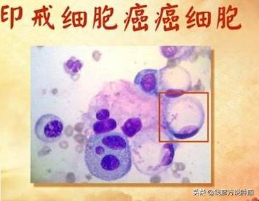 印戒细胞癌是胃癌里最严重的吗,印戒细胞癌是胃癌早期最严重的吗