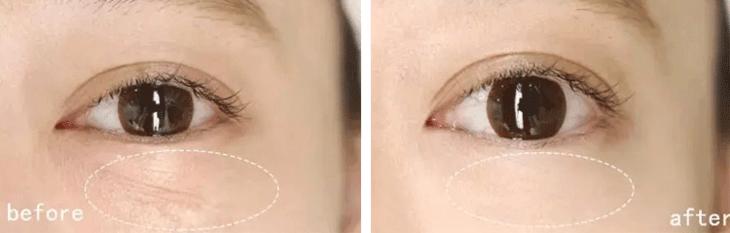 玻尿酸做眼罩方法,玻尿酸冻干眼罩