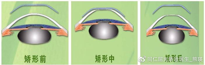 真性近视裸眼视力好转是好事吗,近视手术是怎样让眼睛恢复视力的