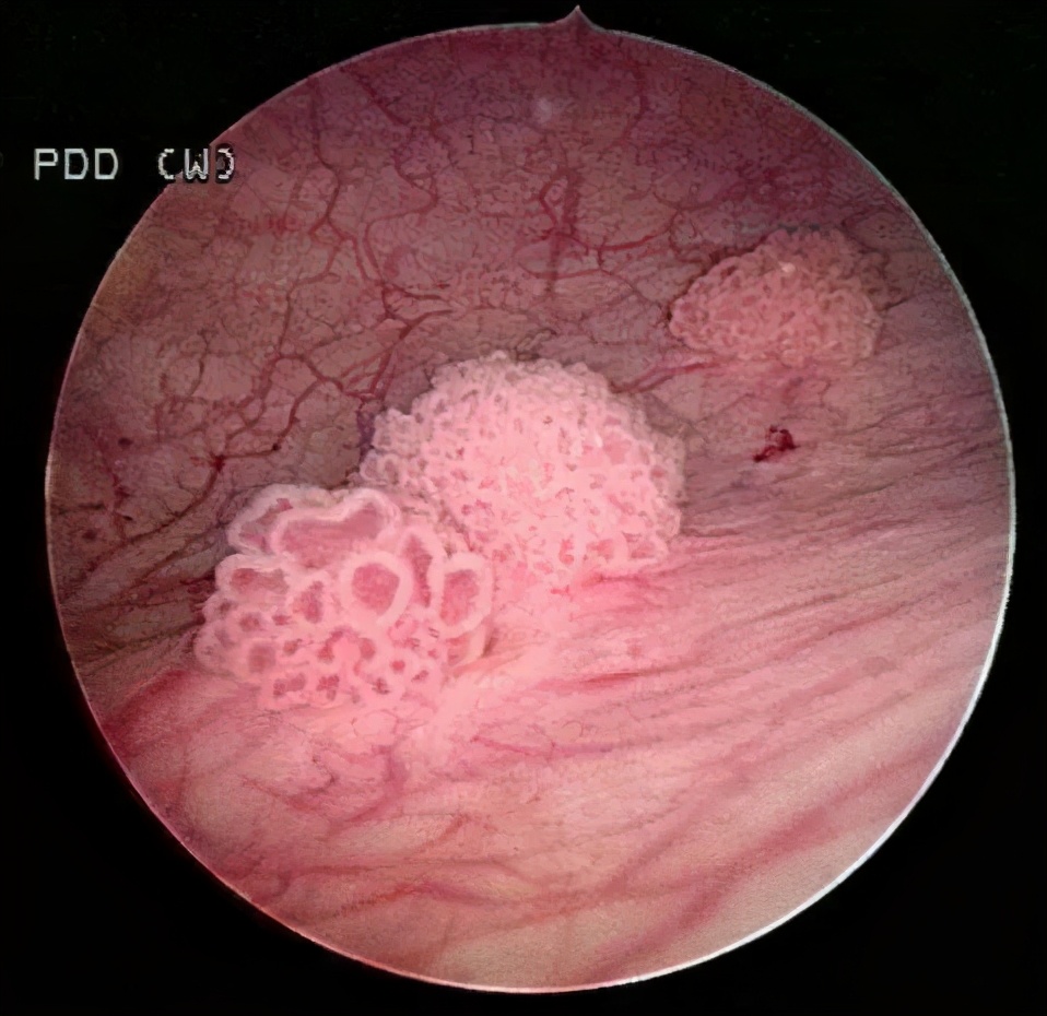小便带血尿血是什么原因,小便带血是什么原因