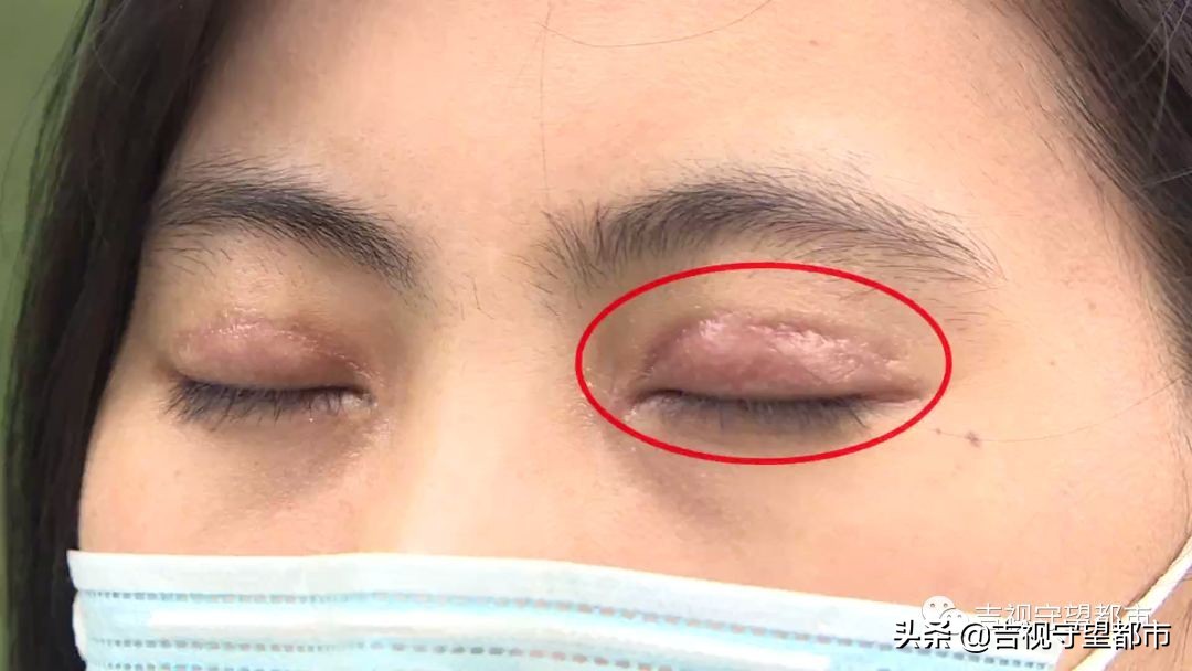 公寓做双眼皮效果好吗,私人公寓做的双眼皮失败了