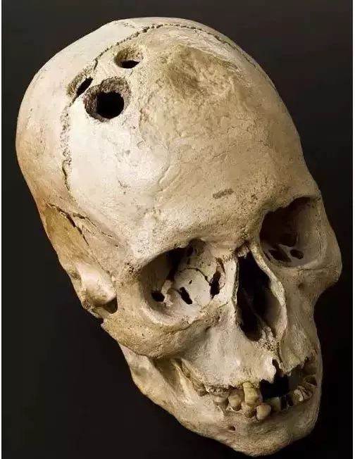 电击、开颅、切脑，为了治病精神病患者受过多少罪