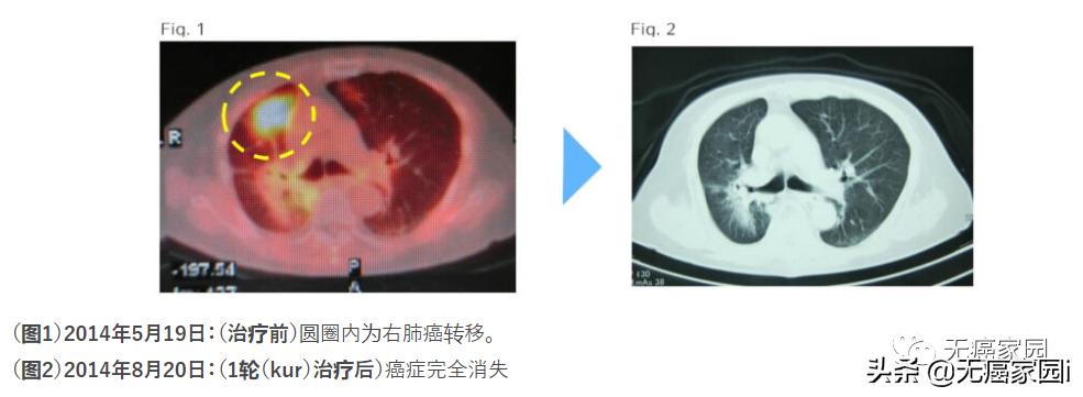 诺贝尔医学奖治疗癌症,诺贝尔医学奖治愈癌症