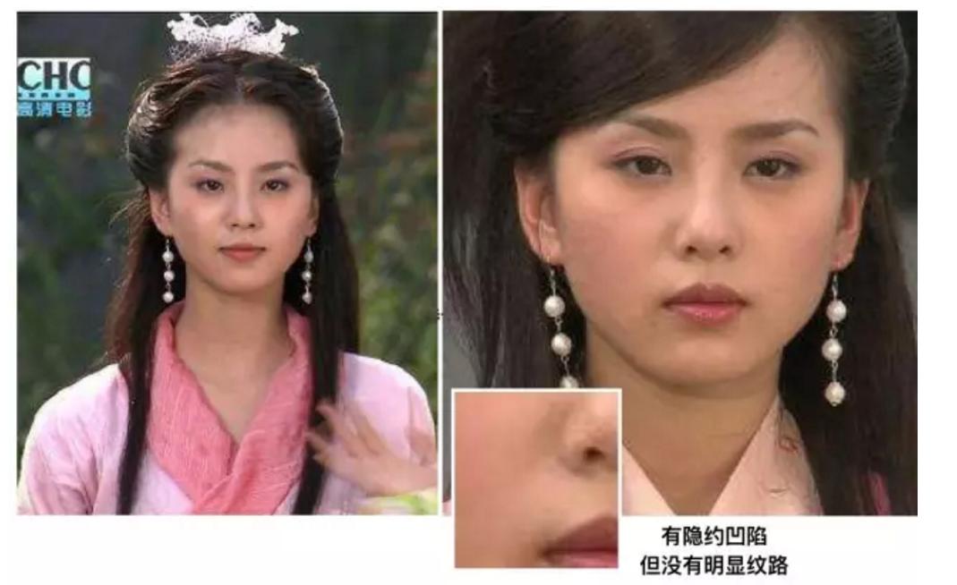 少年法令纹和痘坑显老,显老元凶法令纹