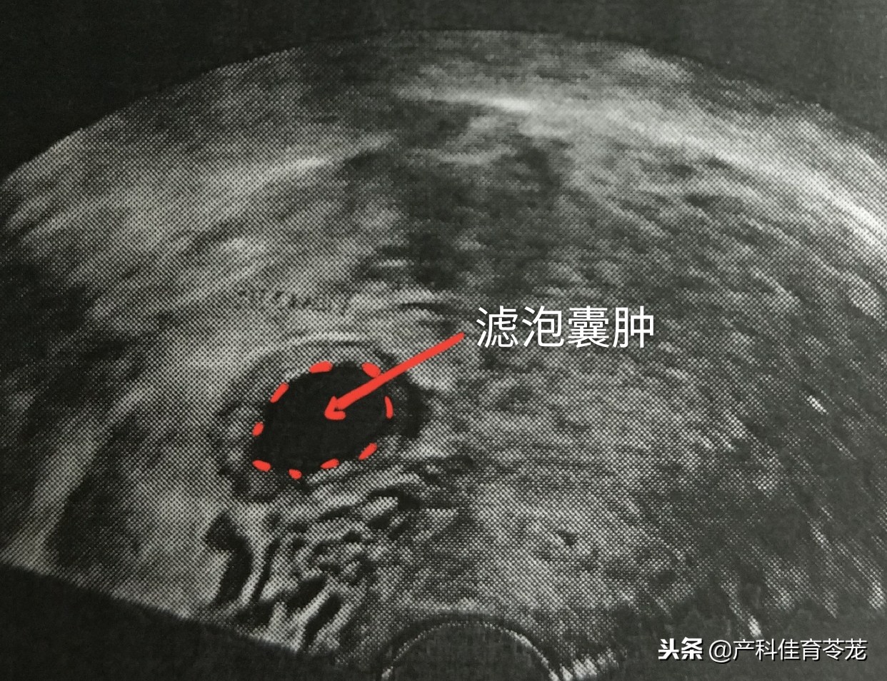 卵巢囊肿术后还有囊肿,卵巢囊肿是肿瘤性囊肿怎么治疗