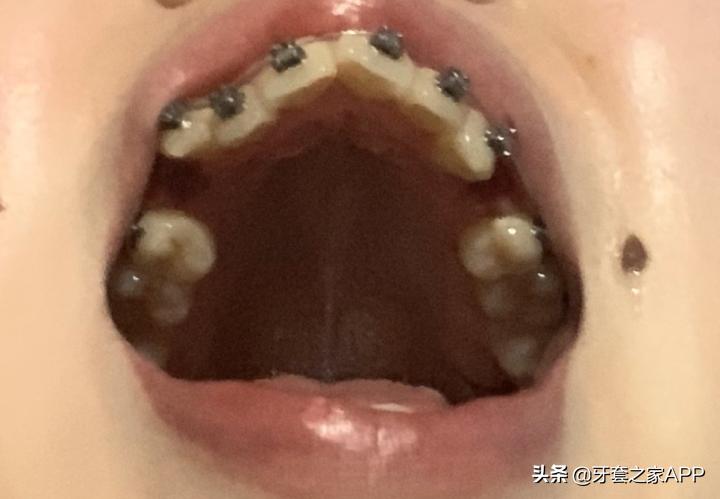 不靠整容怎么改变下巴后缩？看这里