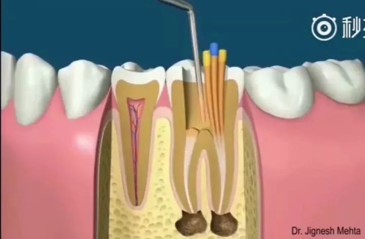 蛀牙了十几年还需要做根管治疗吗,蛀牙了一个小洞要根管治疗吗