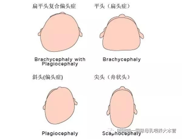 宝宝睡的扁长头如何纠正,宝宝睡觉头睡扁了怎么回事