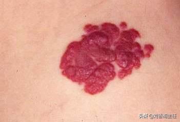 婴儿血管瘤为什么非治不可?我用一组漫画告诉您