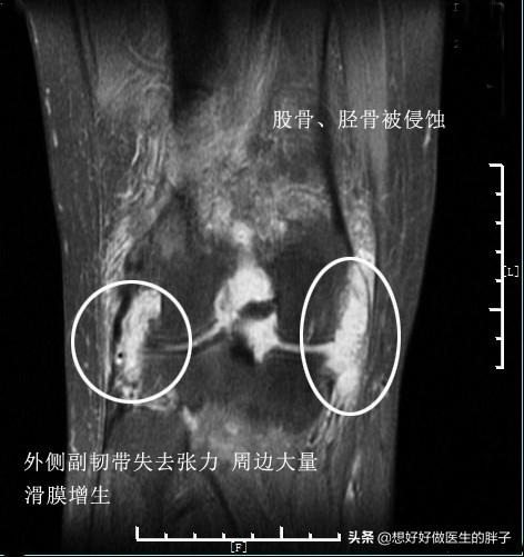 膝盖积水用烤灯能烤好吗？粗盐呢？医生：明确诊断针对治疗是关键