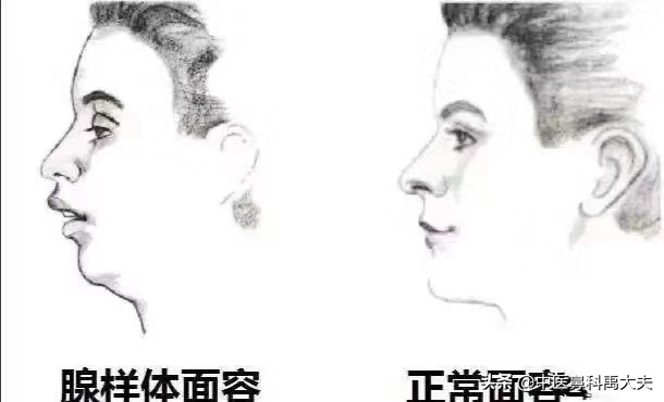 什么是腺样体肥大面容图片,腺样体肥大是什么样子的