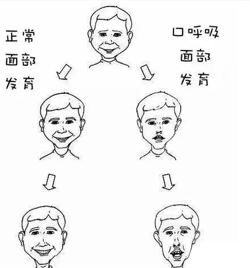 华西治疗打鼾最厉害的医生,华西治疗打鼾会先睡眠监测吗