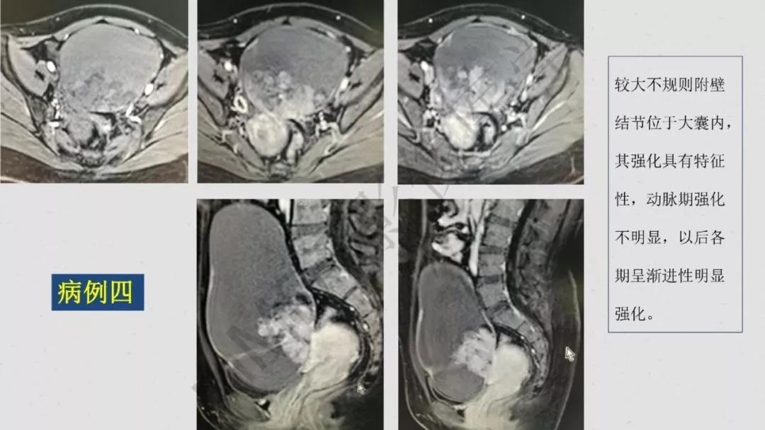 卵巢原发肿瘤的分析思路