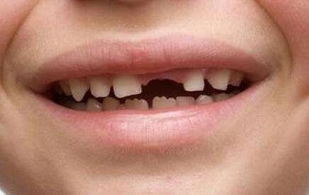 乳牙拔出恒牙不长在原来的位置,孩子的乳牙迟迟不掉怎么回事