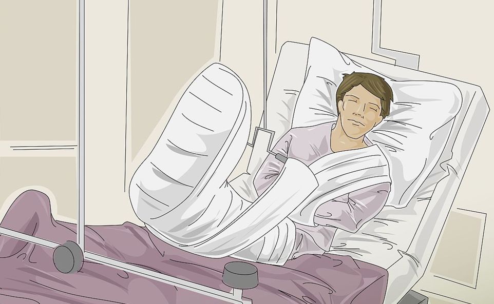 骨折后多久能下地活动？有具体的时间吗？