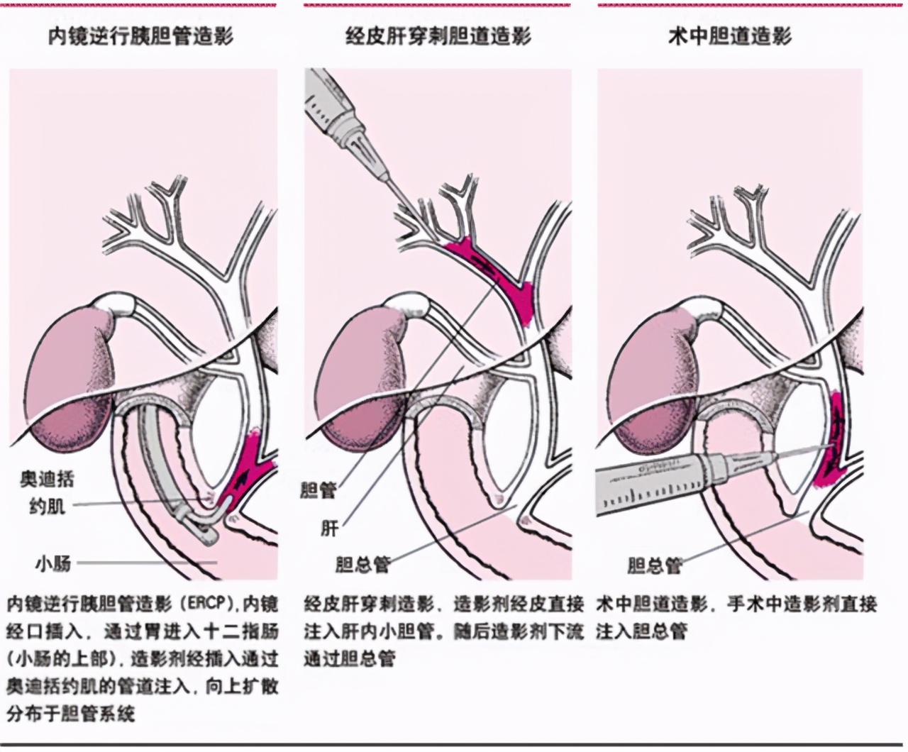 胆囊炎引起胃痛严重吗怎么治疗好,胆囊炎症状和胃病怎么区分