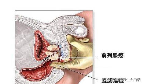 肛门坠胀怎么治疗最好,肛门坠胀怎么治疗快好