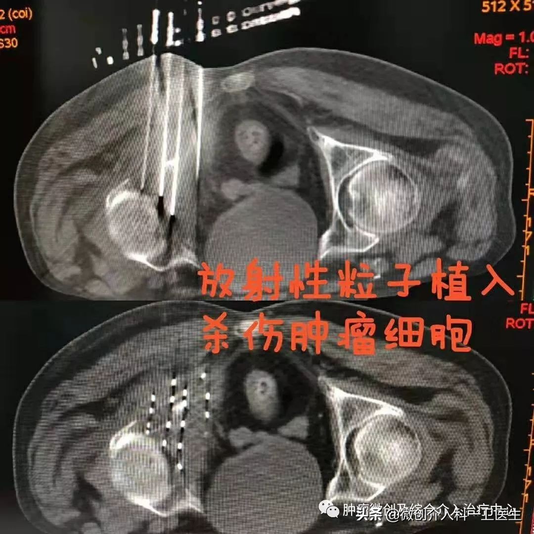 四川肿瘤医院碘125粒子植入术,肿瘤碘125粒子植入术图片
