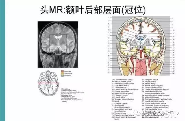 电子版头颅ct与mri断层解剖,头颅mri血管解剖与分段详解