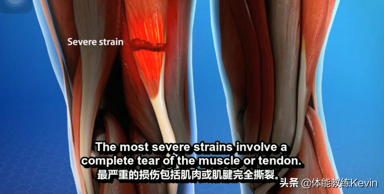 腘绳肌拉伤恢复训练方法,预防腘绳肌拉伤的方法