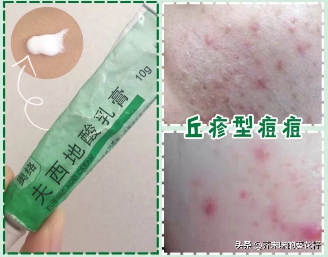 不同部位痘痘消除方法小学生,不同类型的痘痘的祛痘方法