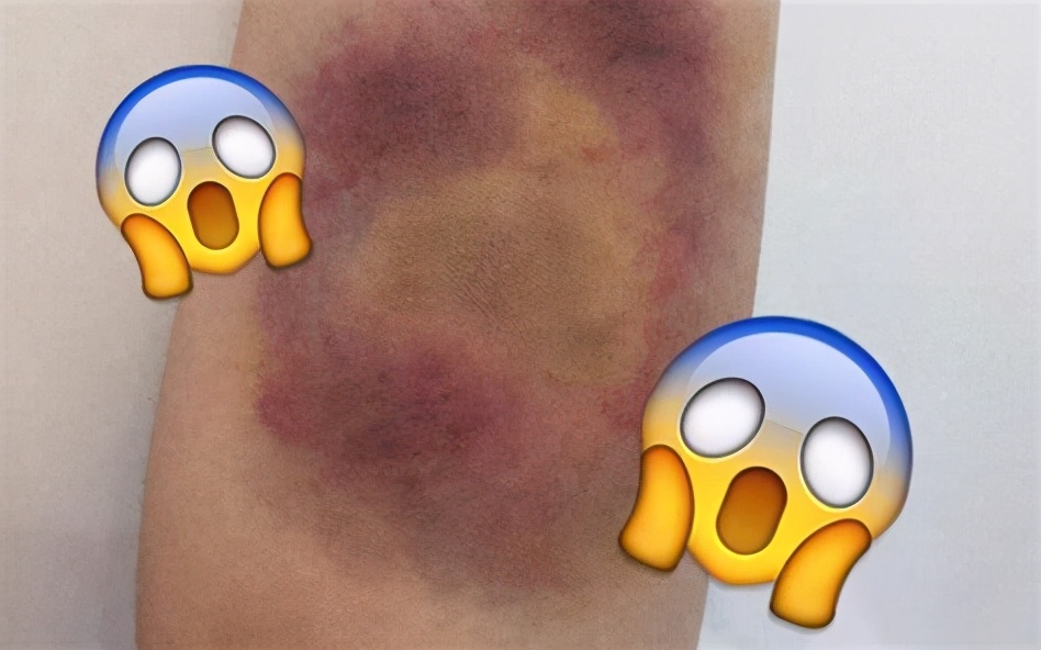 腿上为什么会莫名其妙出现淤青,腿上莫名其妙有淤青按压疼