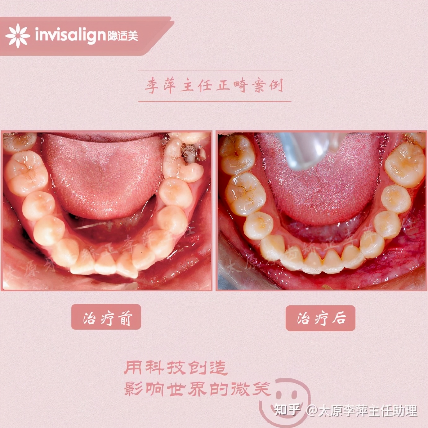 太原矫正牙齿需要做正颌吗,太原牙齿二次矫正