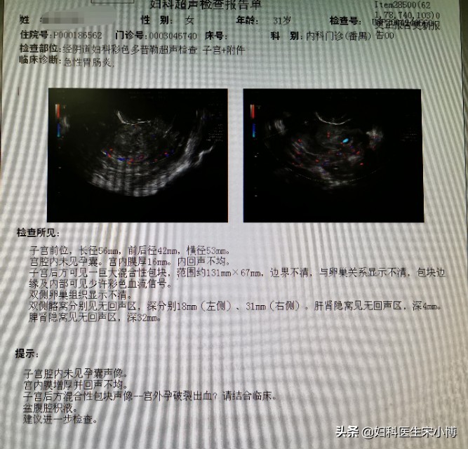 你了解宫外孕吗,输卵管间质部堵塞会宫外孕吗