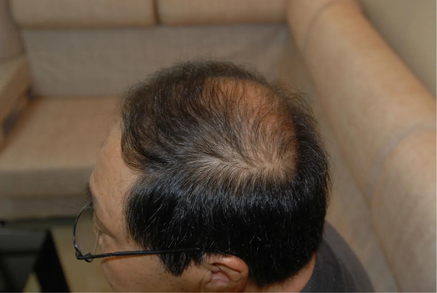 脱发到底该怎么应对,女脱发严重怎么解决