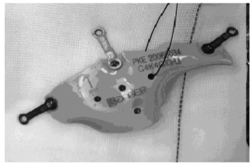 舞蹈演员车祸重获新生,舞蹈演员遇车祸