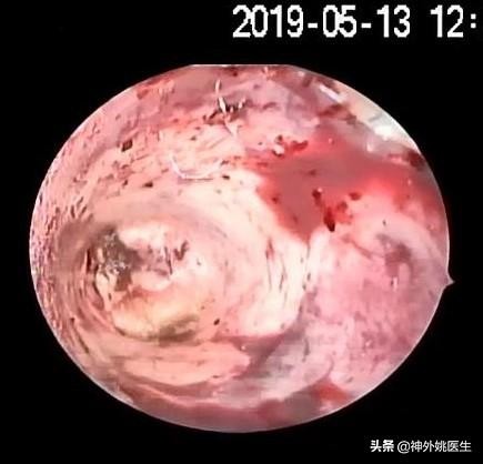 微创手术后血肿是什么,颅内血肿微创清除术多少钱