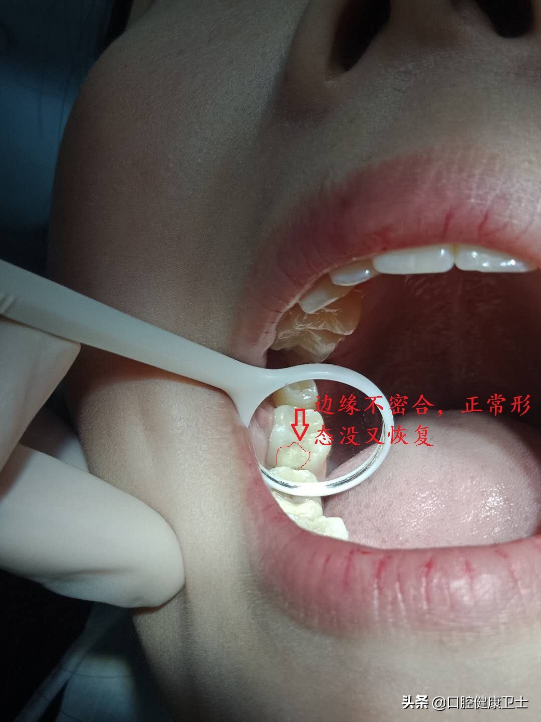 补牙后的牙缝越来越大怎么办,补牙之后牙缝塞东西导致牙龈痛