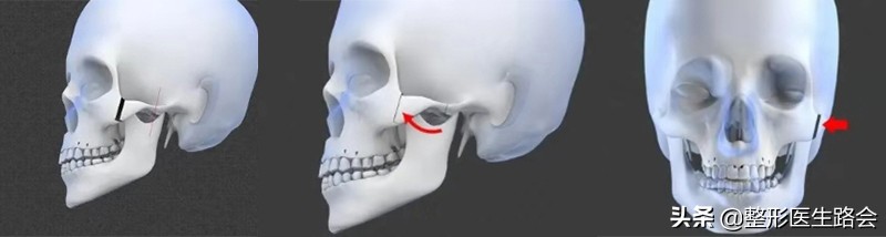 颧骨内推和填充玻尿酸哪个好,太阳穴凹陷颧骨突出填充还是内推
