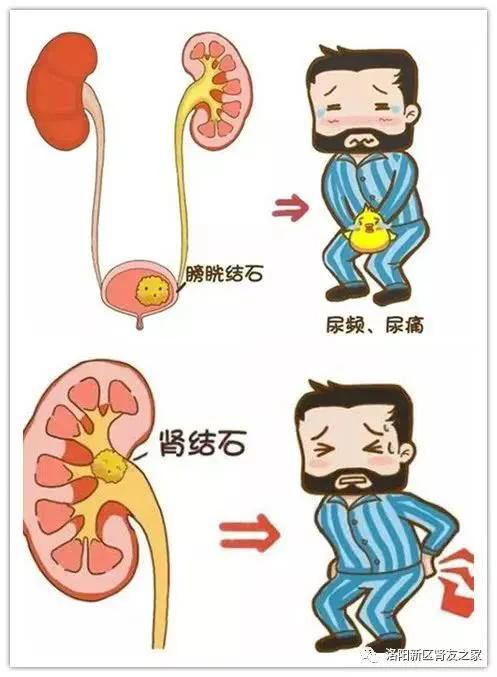 导致肾结石发病的诱因是什么,肾结石的症状怎么治疗