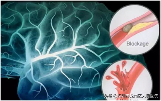 龙岗区人民医院“三大中心”前世今生之“卒中中心”首批获中国卒中中心联盟认证授牌