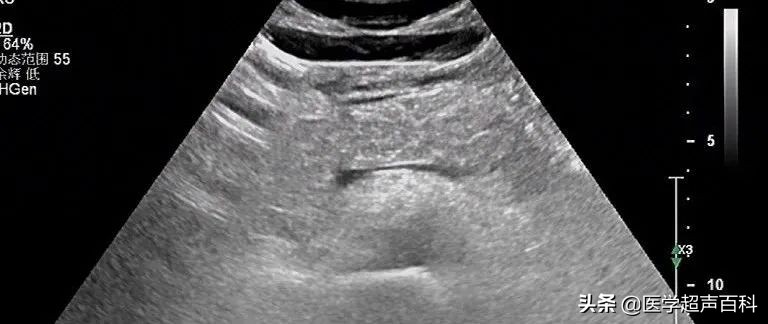 常见的消化系统疾病——急性胰腺炎，超声表现、诊断及治疗