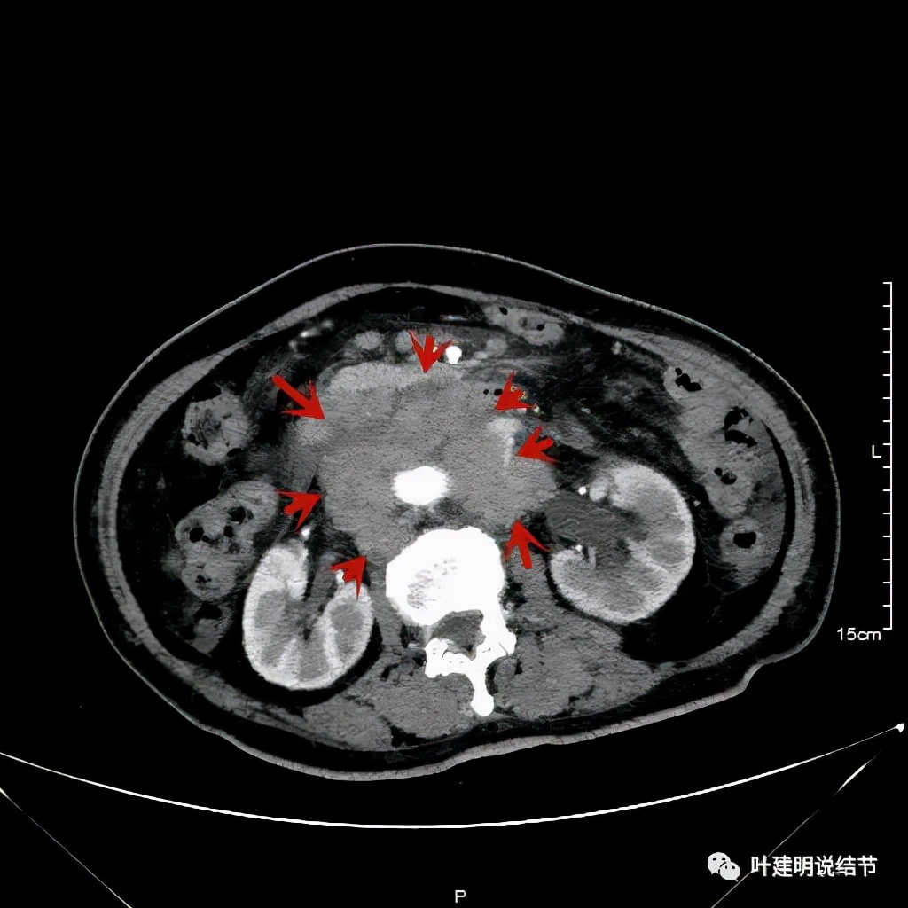 特瑞普利单抗食管癌成功案例,特瑞普利单抗治疗食管癌效果好吗