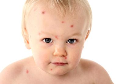 起水痘怎么办？老祖宗妙招，吃它可以一天见效！