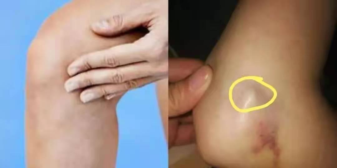 手上长个包不痛不痒会不会是肿瘤,手上长了个肿块