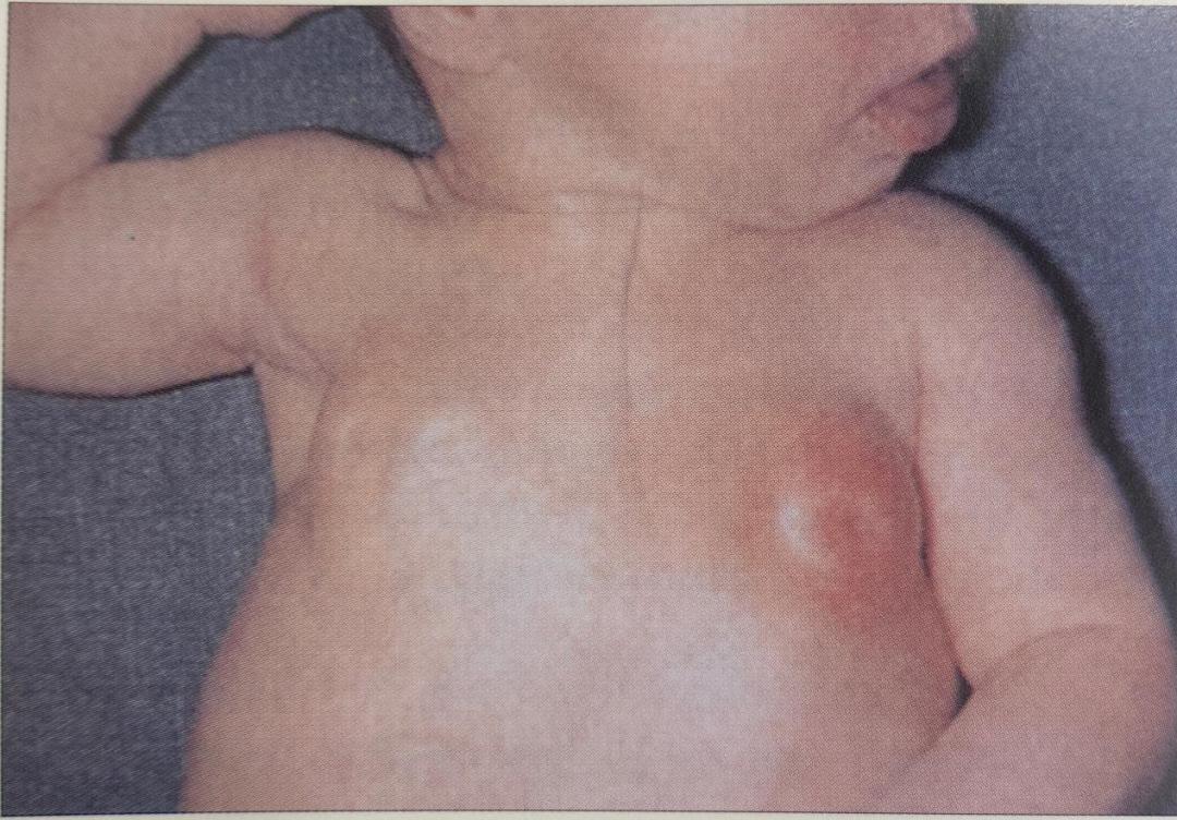 新生儿常见生理现象及护理方式,新生儿生理黄疸现象