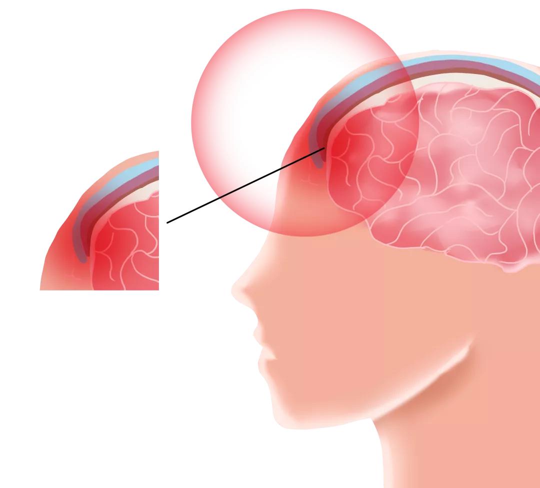 儿童发烧头疼是不是脑炎,孩子发烧脑膜炎千万别这样做