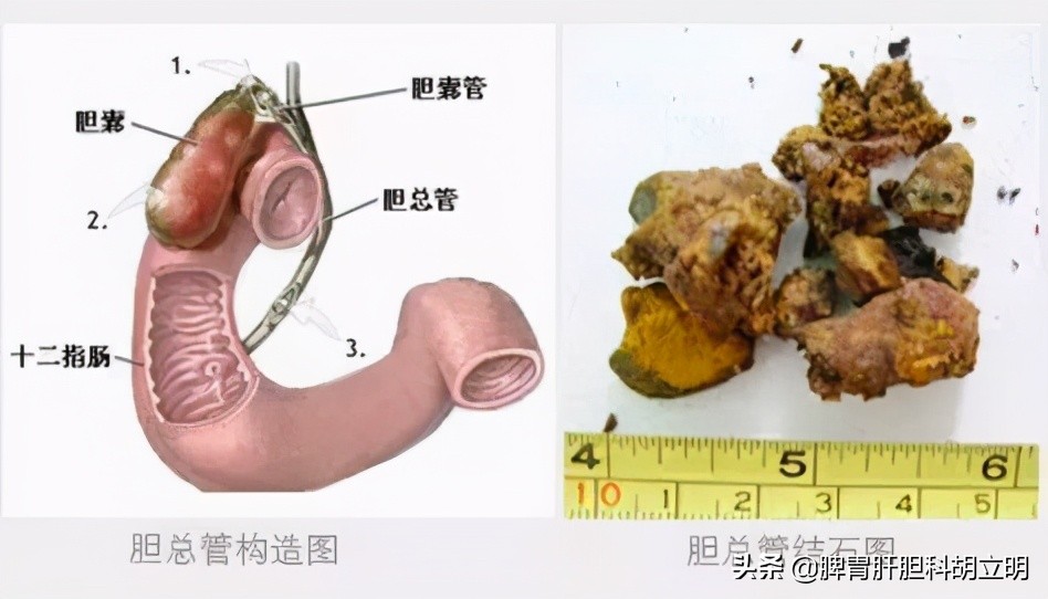 慢性胆囊炎是怎么引起的,慢性胆囊炎都是由什么引起的