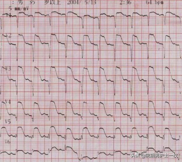 急性心梗的紧急处理视频,一旦发现急性心梗如何救