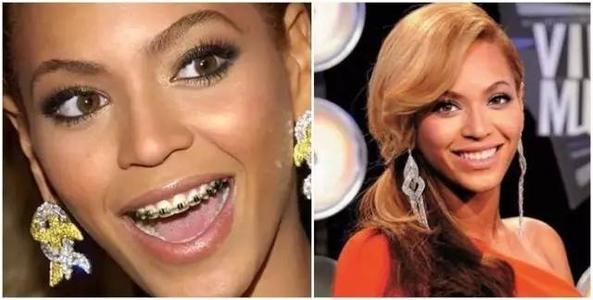 吴宣仪做牙齿前后对比,吴宣仪做整牙